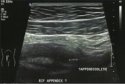 Boosey Ultrasound - Appendicitis_1